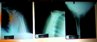shoulder.jpg